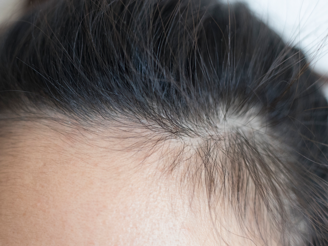 頭の髪の毛が薄くなり始めた女性の頭部の画像